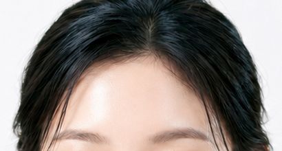 고우리 이마 시술 부위 이미지